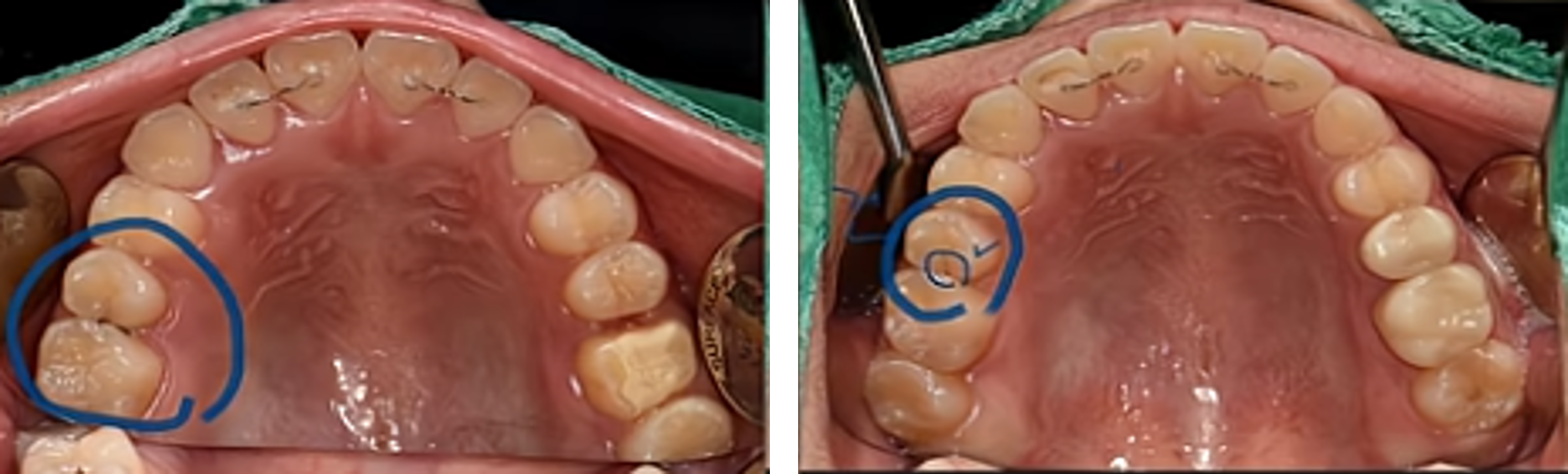 치아 정기 검진이 중요한 이유