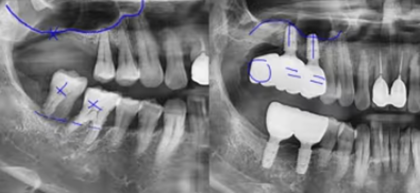 잇몸뼈가 없다면, 상악동거상술