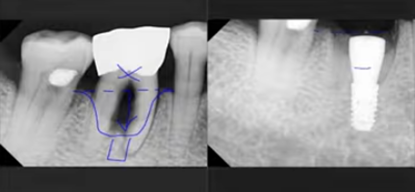 임플란트를 깊게 심어야 하는 이유..