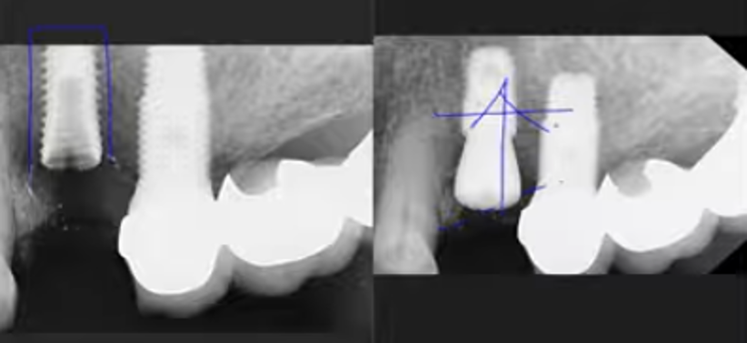 타 치과에서 깨진 임플란트 재수술..