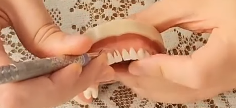 잇몸 속 돌과 때를 제거하는 잇몸스케일링