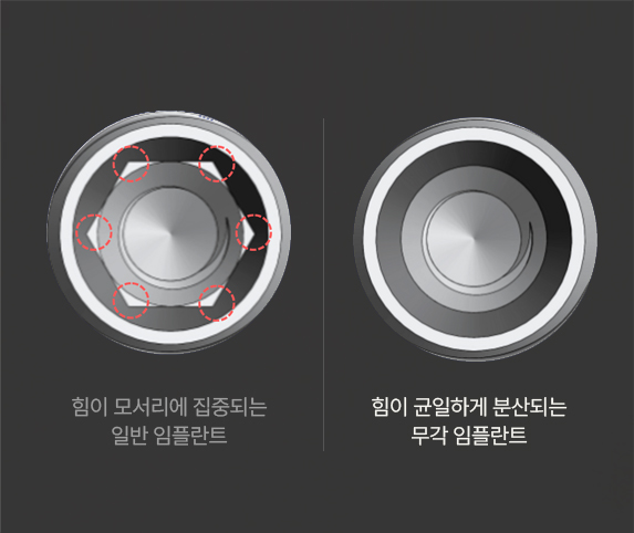 서울정성치과 무각임플란트