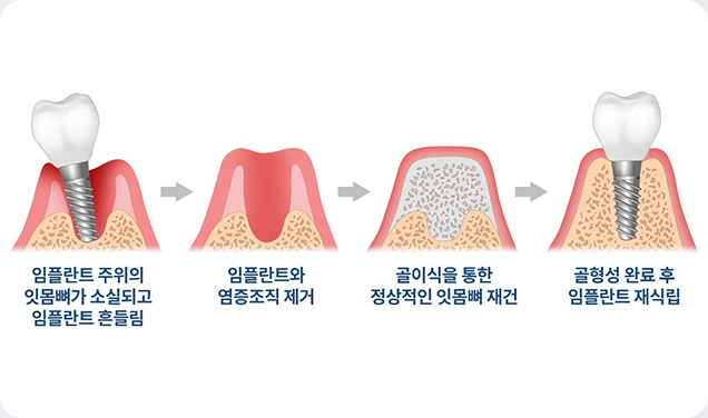임플란트 재치료