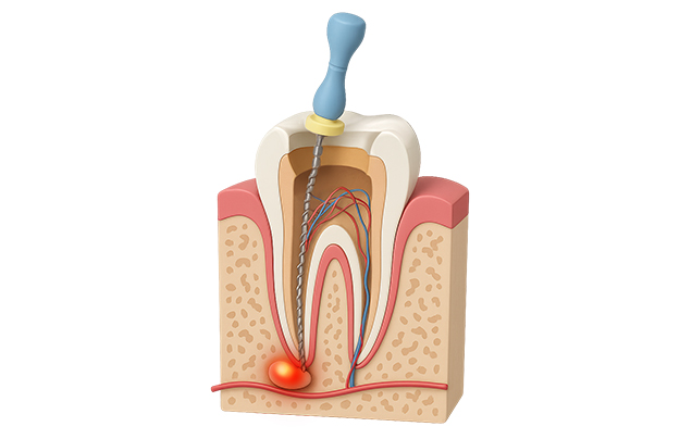 서울이로운치과 신경치료