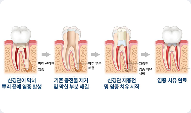 서울이로운치과 MTA신경치료