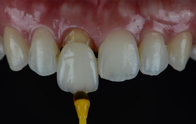 서울이로운치과 보철치료